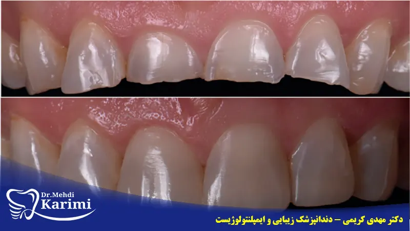کامپوزیت دندان های قدامی