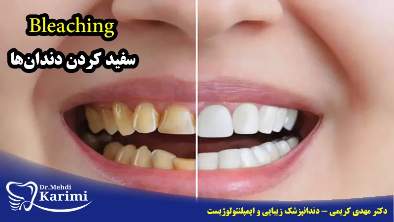 بلیچینگ-سفید کردن دندان