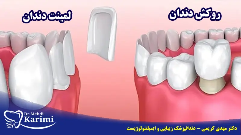 تفاوت لمینت دندان با روکش