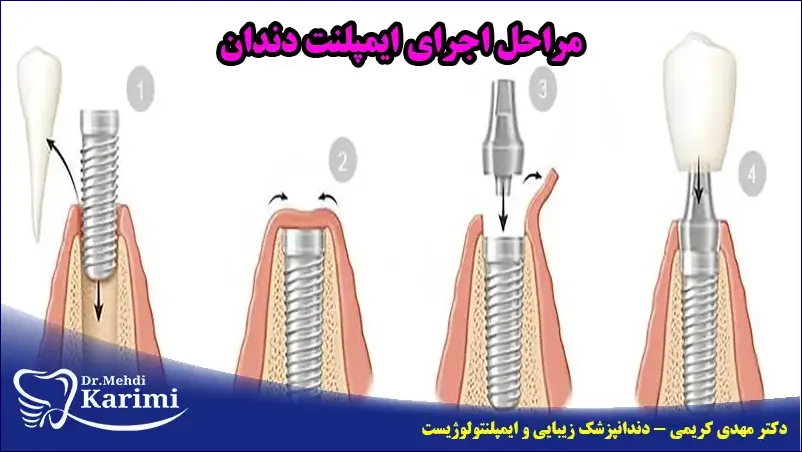 مراحل اجرای ایمپلنت دندان