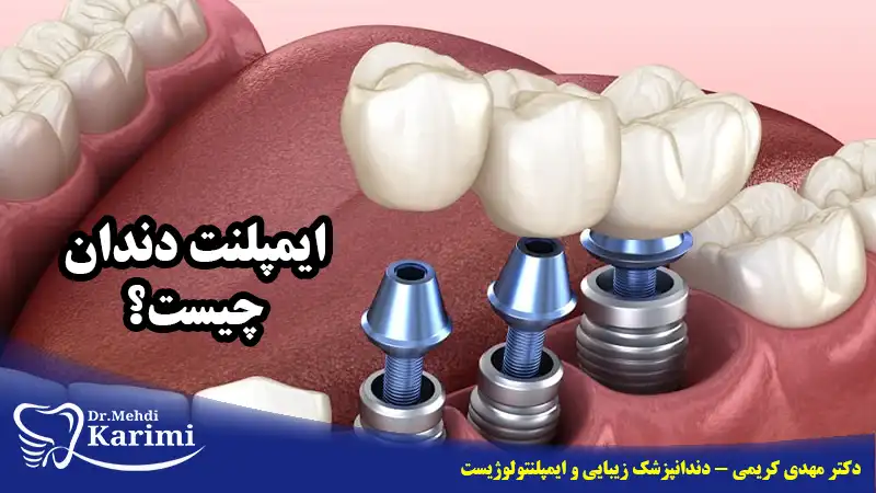 ایمپلنت دندان چیست؟- دکتر مهدی کریمی