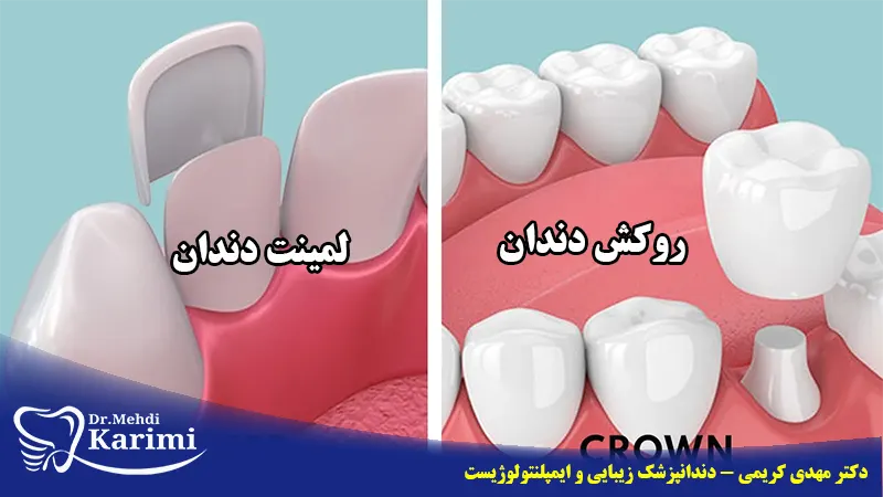 تفاوت لمینت و روکش دندان