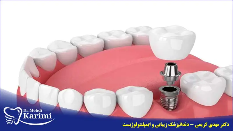 اصول نگهداری از ایمپلنت دندان