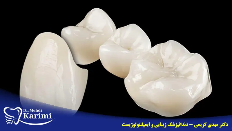 انواع جنس روکش دندان
