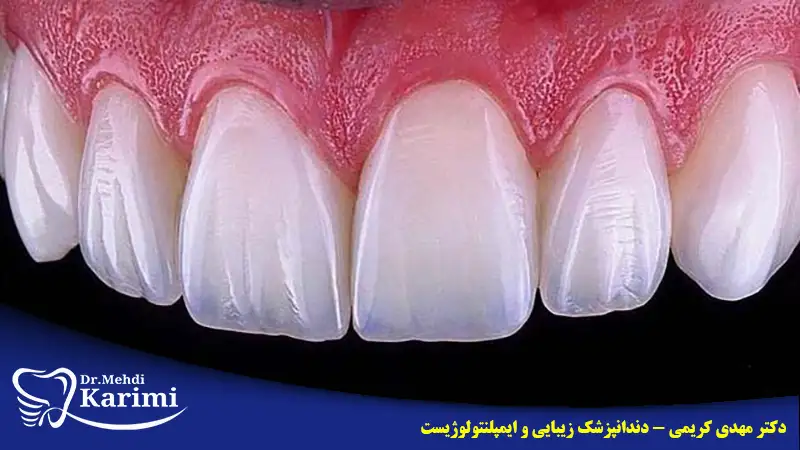 کاربرد لمینت دندان