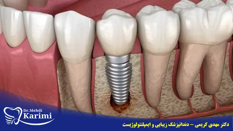 لقی ایمپلنت دندان