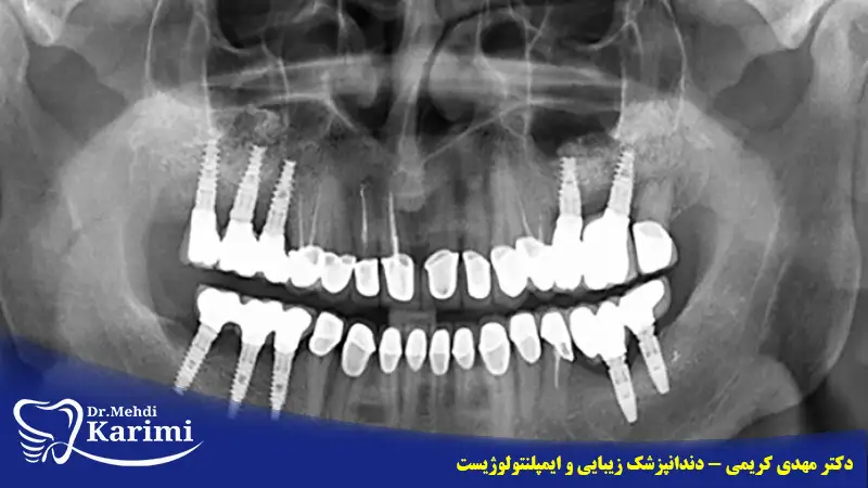 رادیوگرافی ایمپلنت دندان