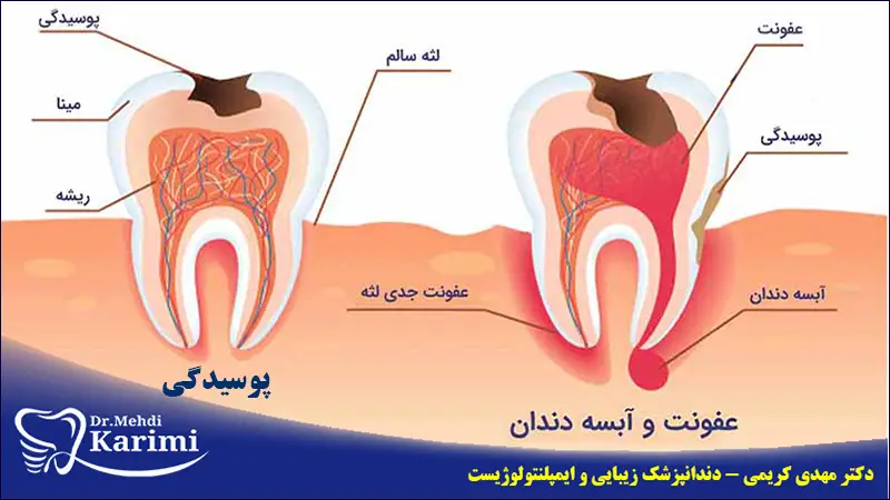 مراحل آبسه دندان