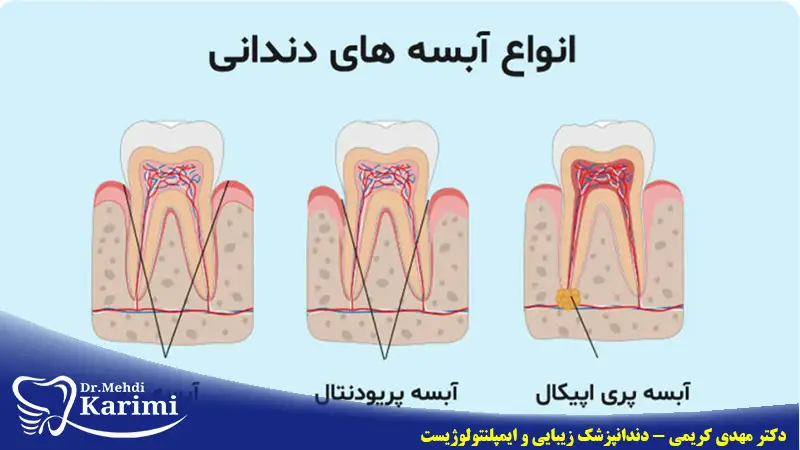 انواع آبسه دندان