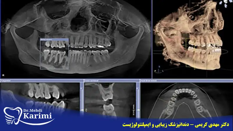 رادیوگرافی CBCT دندان