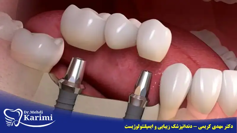 درد ایمپلنت دندان