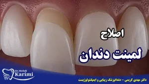 اصلاح لمینت دندان- دکتر مهدی کریمی