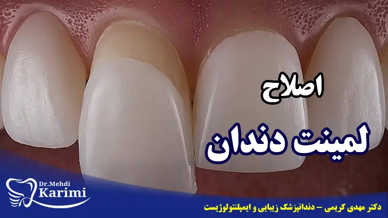 اصلاح لمینت دندان- دکتر مهدی کریمی