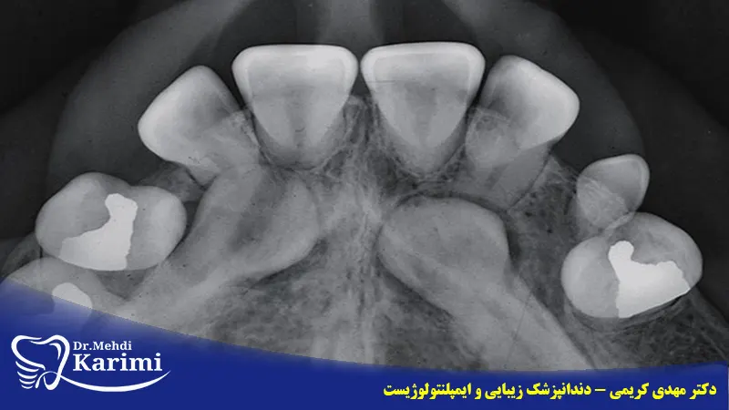 رادیوگرافی اکلوزال دندان