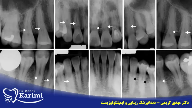 رادیوگرافی پری اپیکال دندان