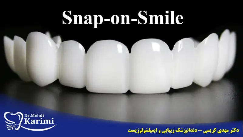 لمینت دندان متحرک یا snap-on-smile