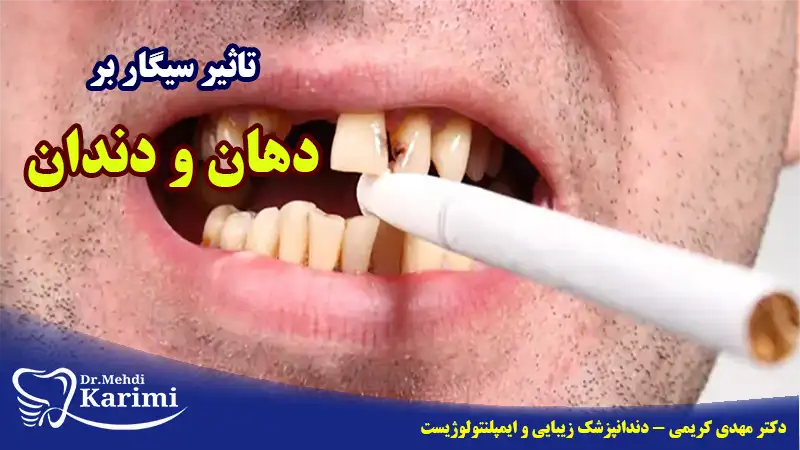 تاثیر سیگار بر دهان و دندان- دکتر مهدی کریمی