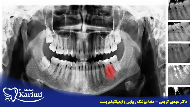 علائم به عصب رسیدن دندان