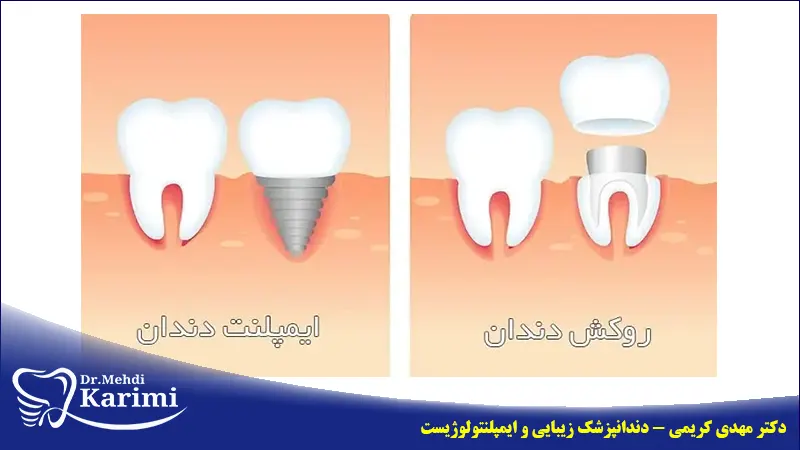 تفاوت روکش و ایمپلنت دندان