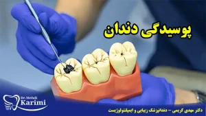 پوسیدگی دندان- دکتر مهدی کریمی